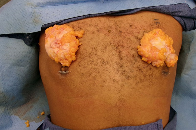 Gynecomastia Surgery Before & After Image