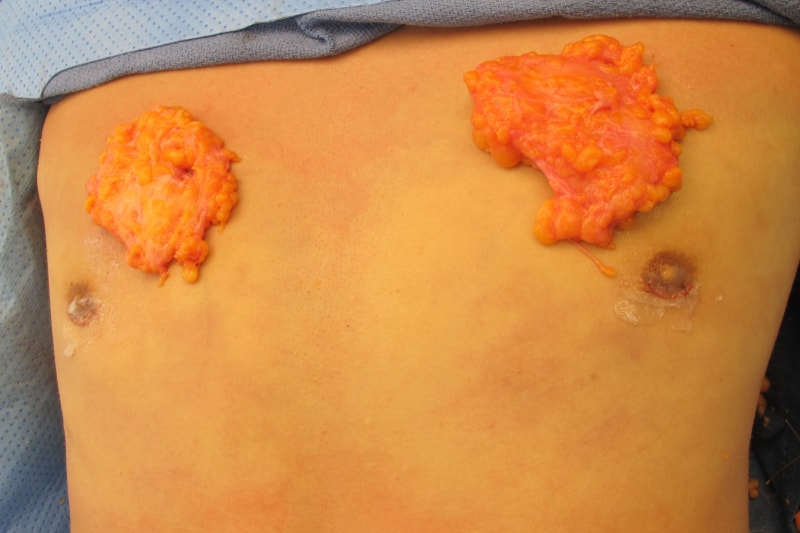 Gynecomastia Surgery Before & After Image