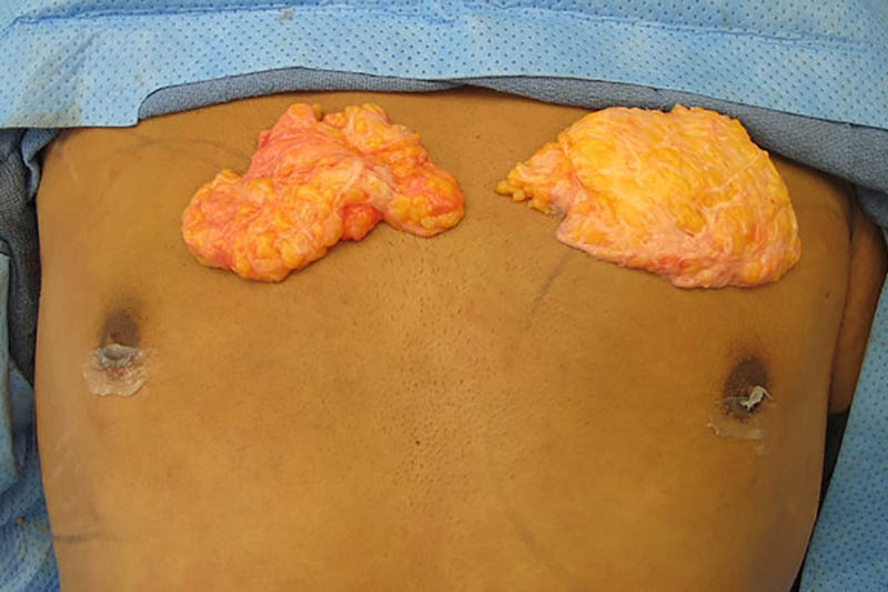 Gynecomastia Surgery Before & After Image