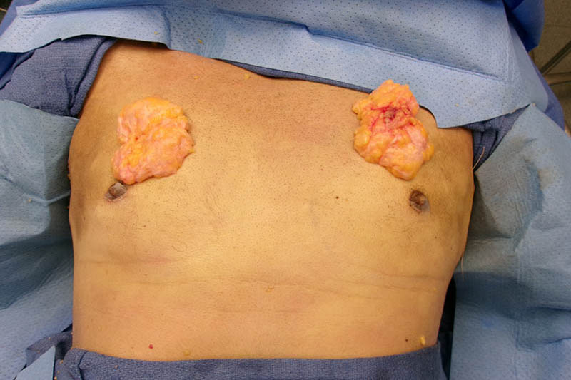 Gynecomastia Surgery Before & After Image