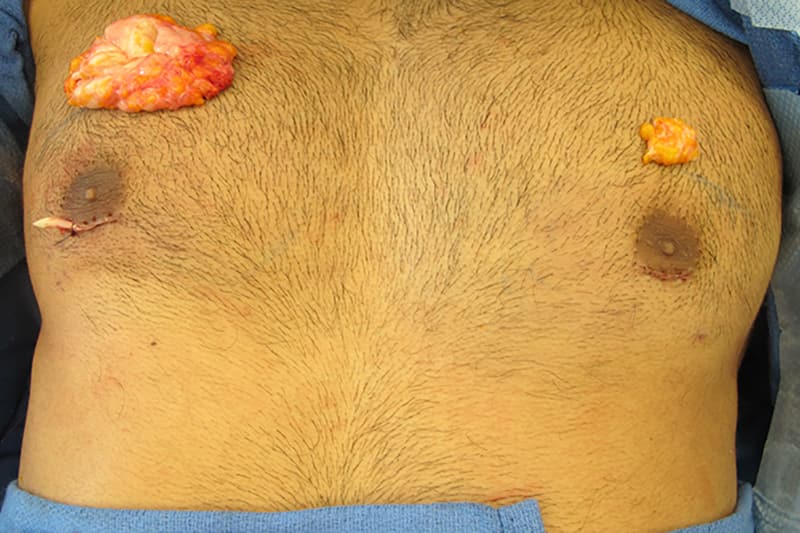 Gynecomastia Surgery Before & After Image