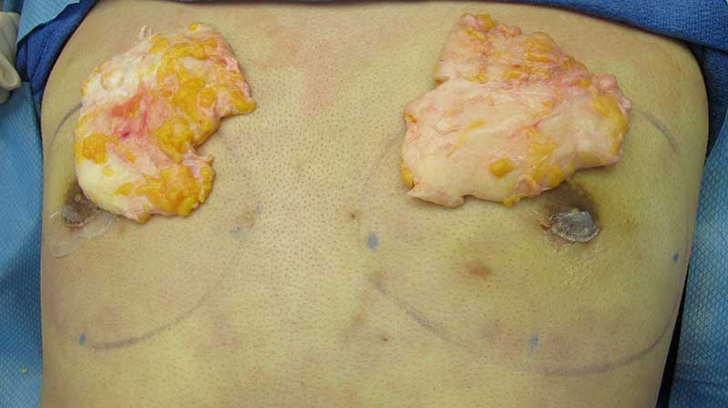 Gynecomastia Surgery Before & After Image