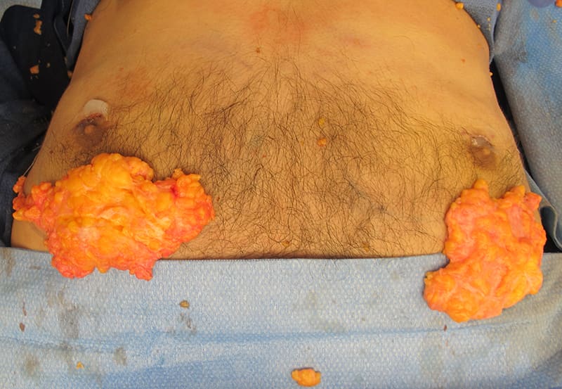 Gynecomastia Surgery Before & After Image