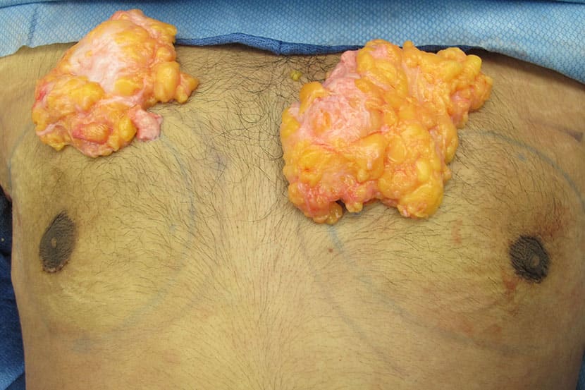 Gynecomastia Surgery Before & After Image