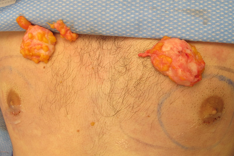 Gynecomastia Surgery Before & After Image