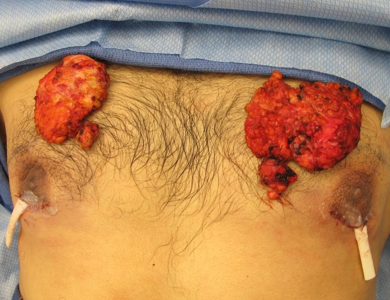 Gynecomastia Surgery Before & After Image