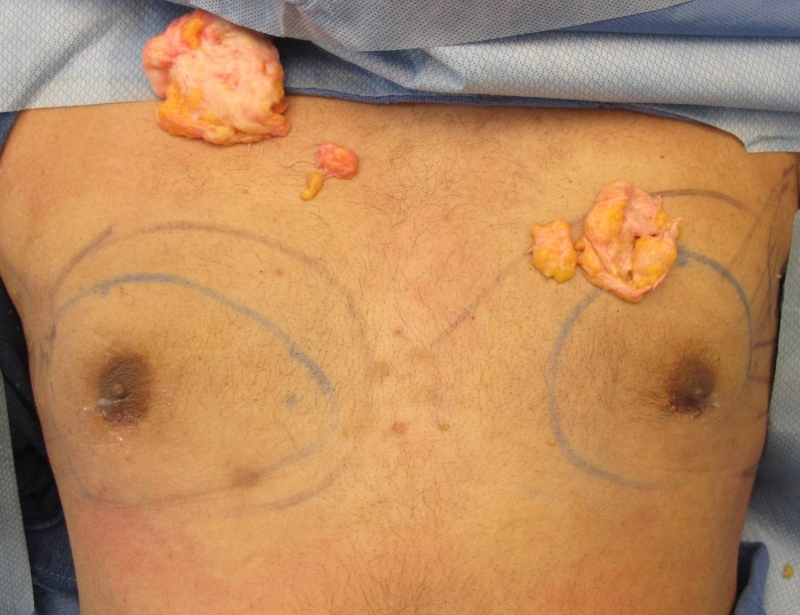 Gynecomastia Surgery Before & After Image