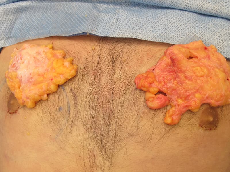 Gynecomastia Surgery Before & After Image