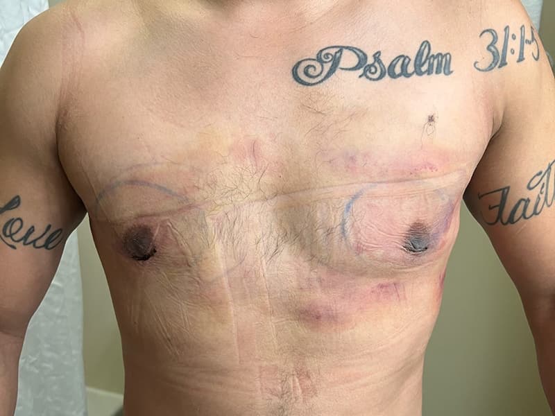 Gynecomastia Surgery Before & After Image