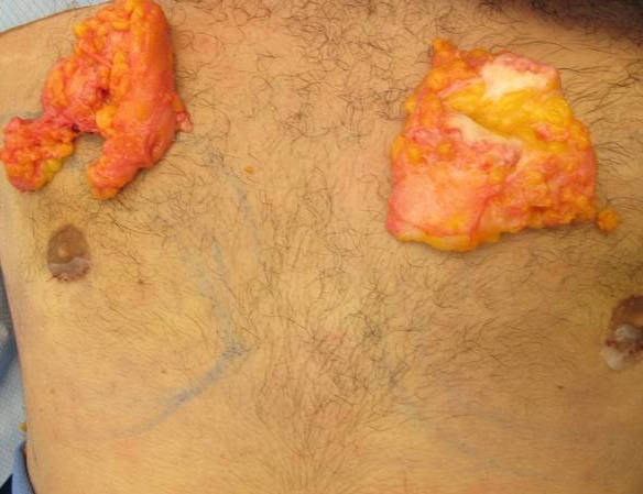 Gynecomastia Surgery Before & After Image