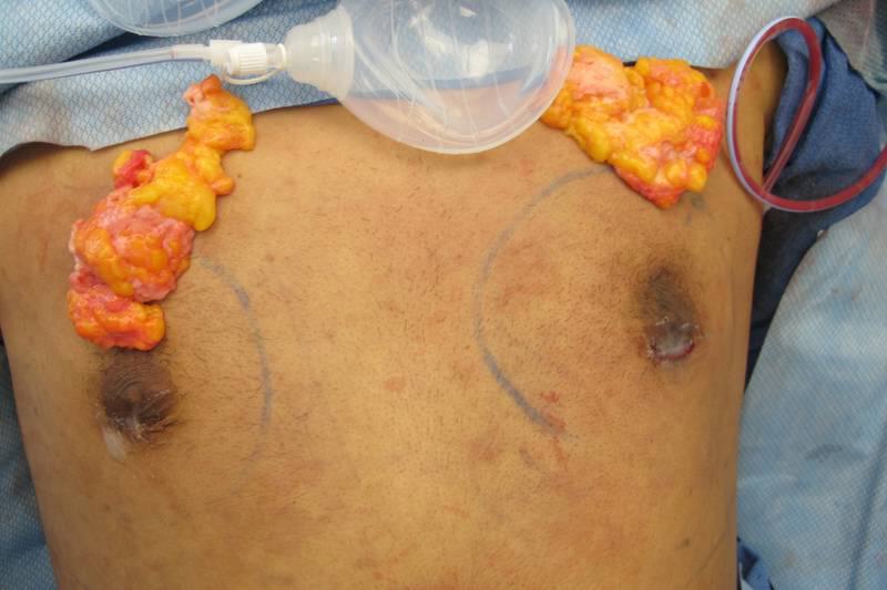 Gynecomastia Surgery Before & After Image
