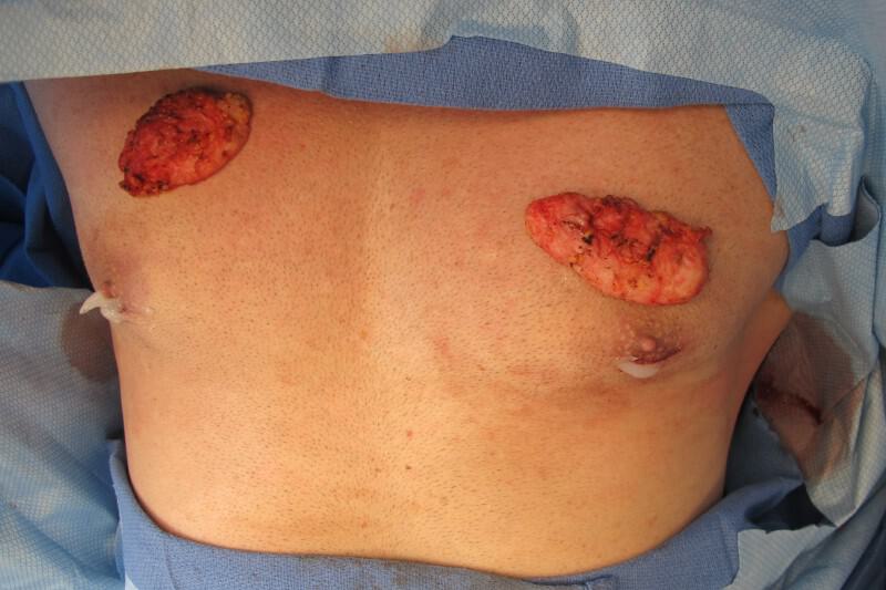 Gynecomastia Surgery Before & After Image