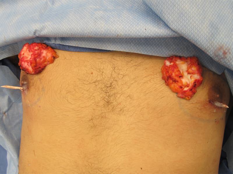 Gynecomastia Surgery Before & After Image