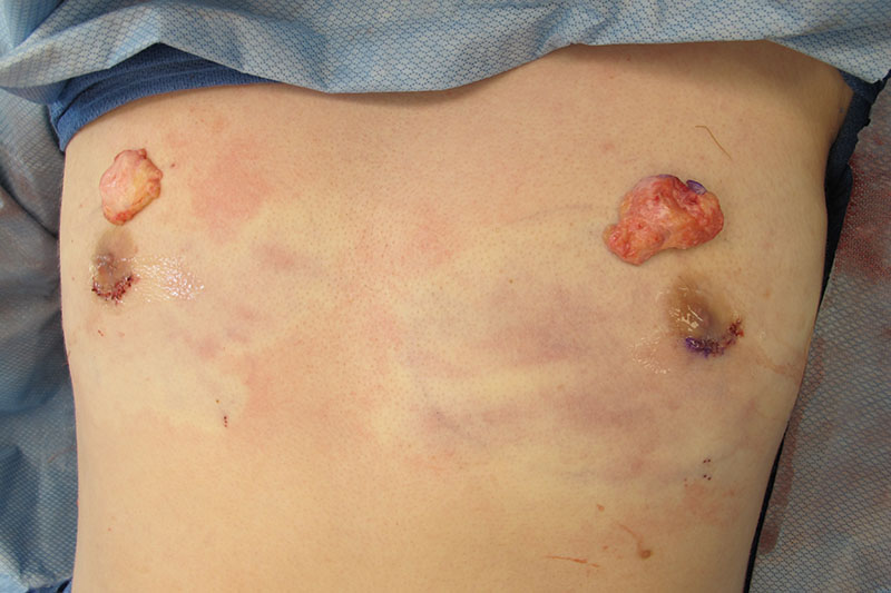 Gynecomastia Surgery Before & After Image