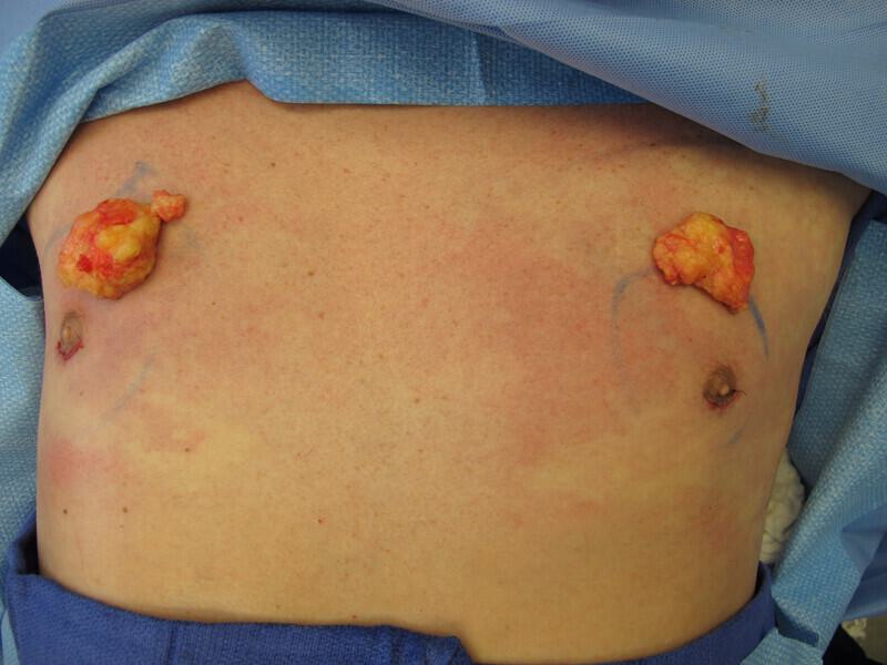 Gynecomastia Surgery Before & After Image