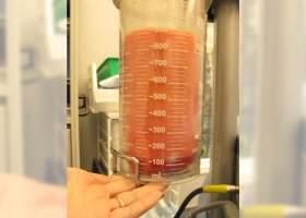 Gynecomastia Surgery Before & After Image