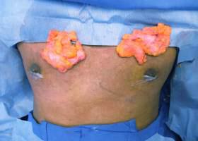 Gynecomastia Surgery Before & After Image