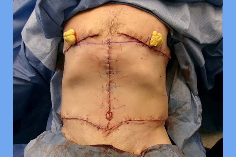 Gynecomastia Surgery Before & After Image