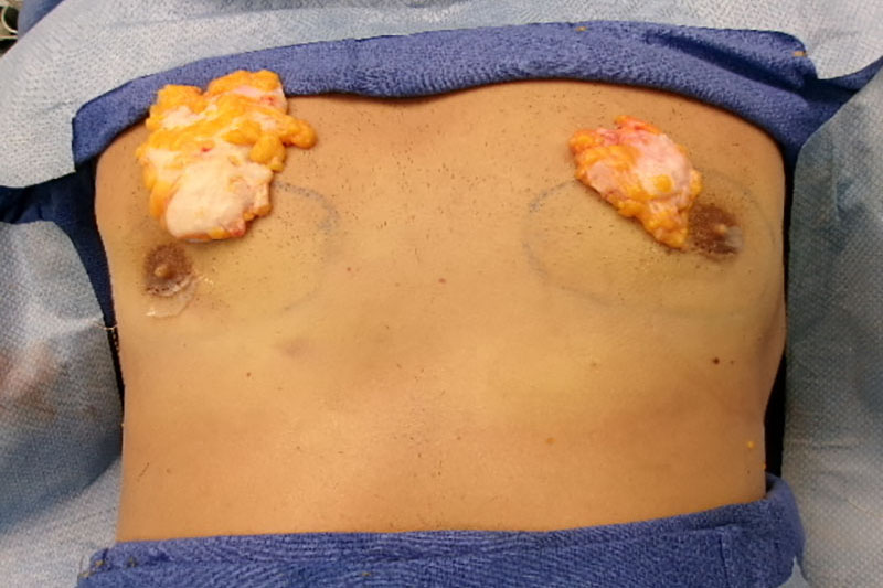 Gynecomastia Surgery Before & After Image