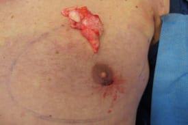 Gynecomastia Surgery Before & After Image