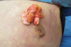 Gynecomastia Surgery Before & After Image