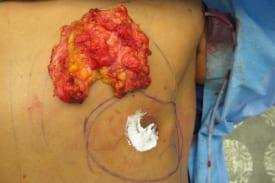 Gynecomastia Surgery Before & After Image