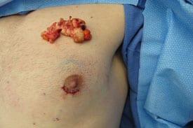 Gynecomastia Surgery Before & After Image