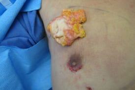 Gynecomastia Surgery Before & After Image