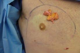 Gynecomastia Surgery Before & After Image