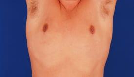 Gynecomastia Surgery Before & After Image