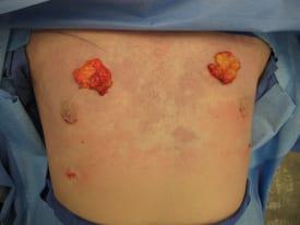 Gynecomastia Surgery Before & After Image