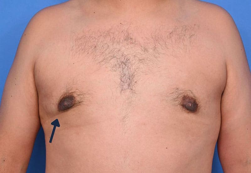 Gynecomastia Surgery Before & After Image