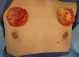 Gynecomastia Surgery Before & After Image