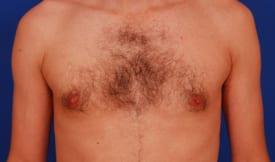 Gynecomastia Surgery Before & After Image