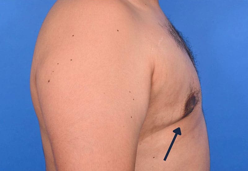 Gynecomastia Surgery Before & After Image