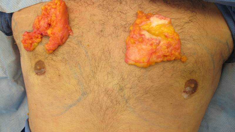 Gynecomastia Surgery Before & After Image