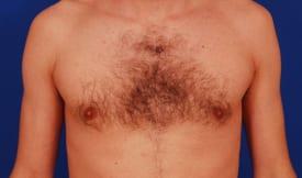 Gynecomastia Surgery Before & After Image
