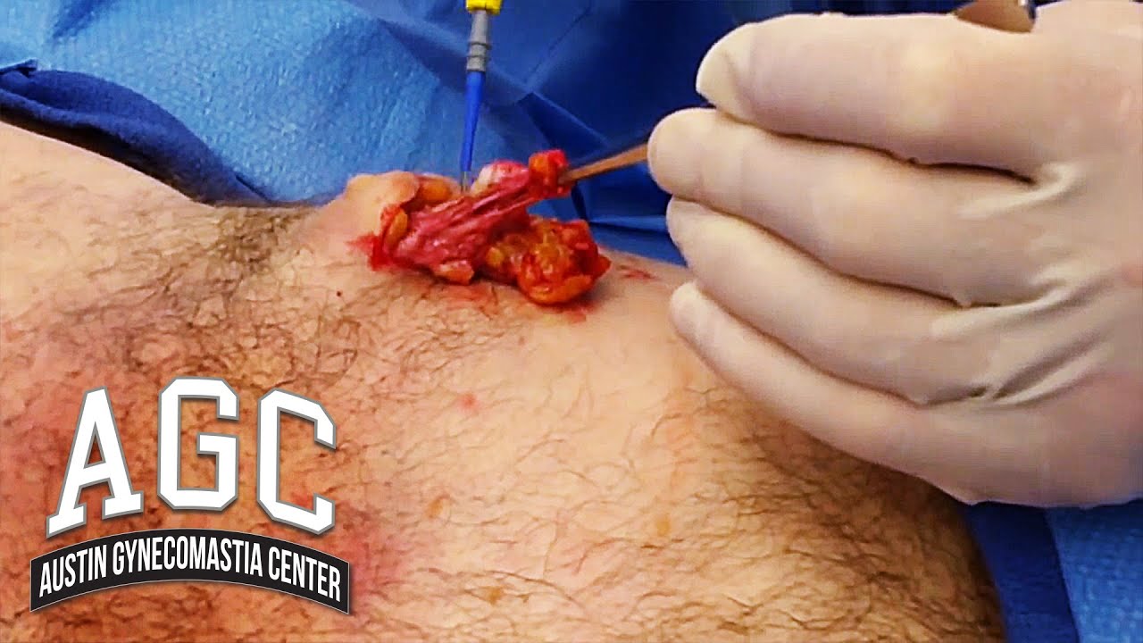 Gynecomastia surgery and chest contouring video