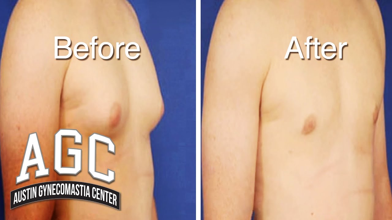 Dr. Caridi discusses gynecomastia video