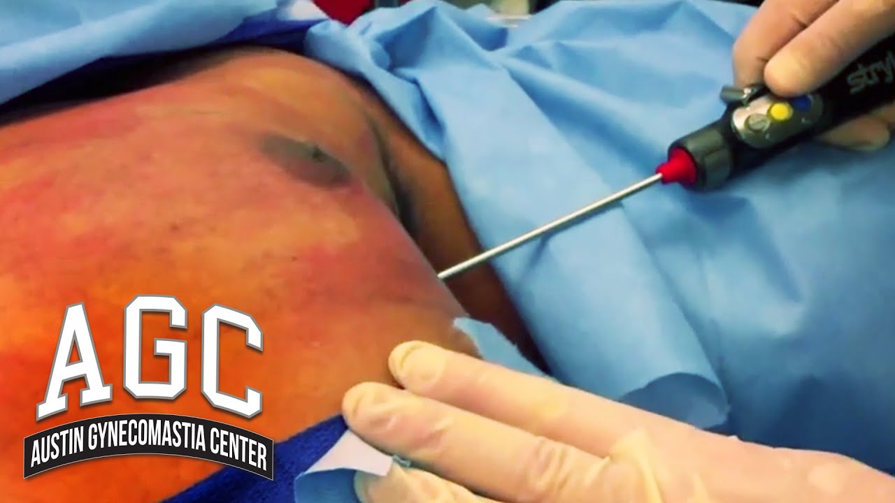 Gynecomastia shaver video