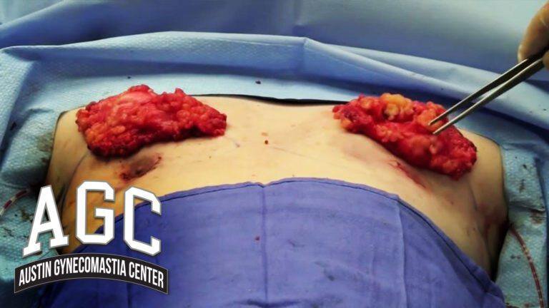 Male breast reduction with Dr. Caridi video
