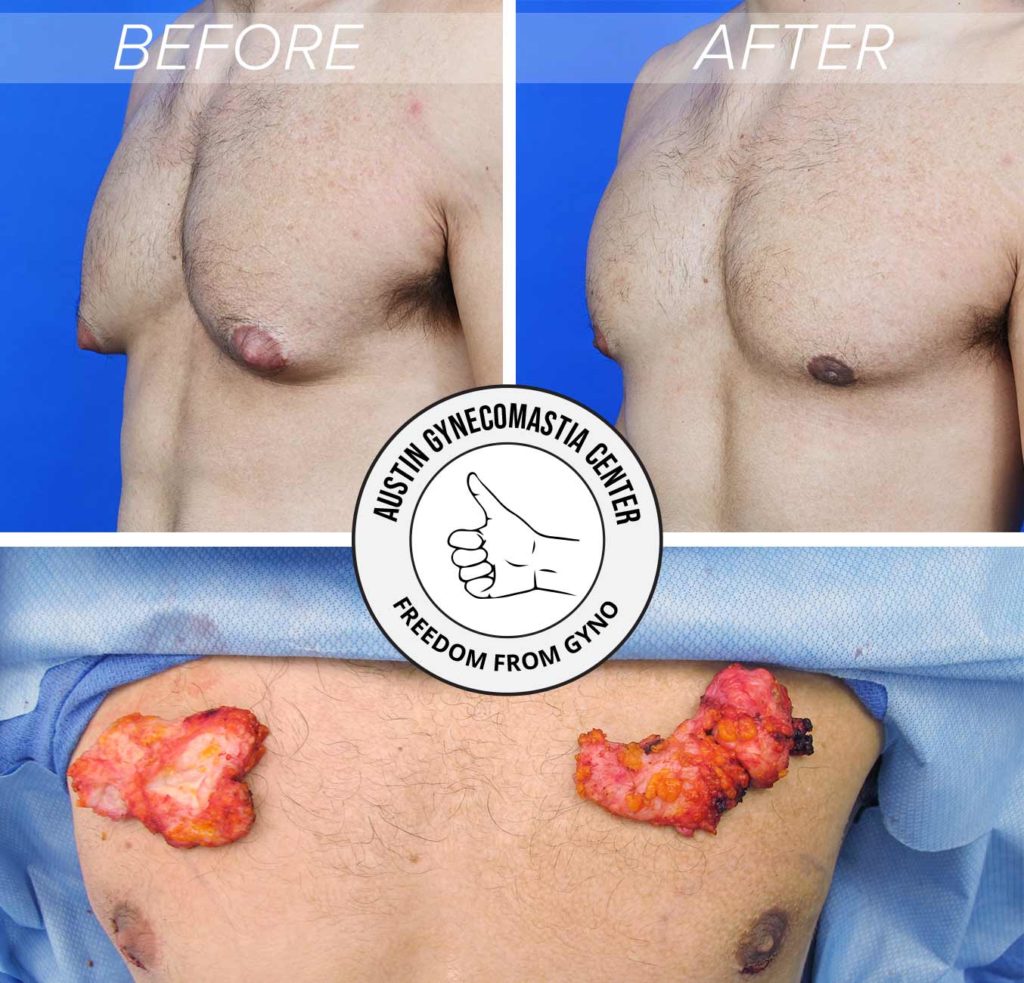 Before and after gynecomastia surgery showing gland removal results
