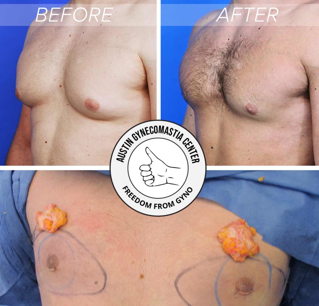 Before and after gynecomastia surgery collage showing gland removal