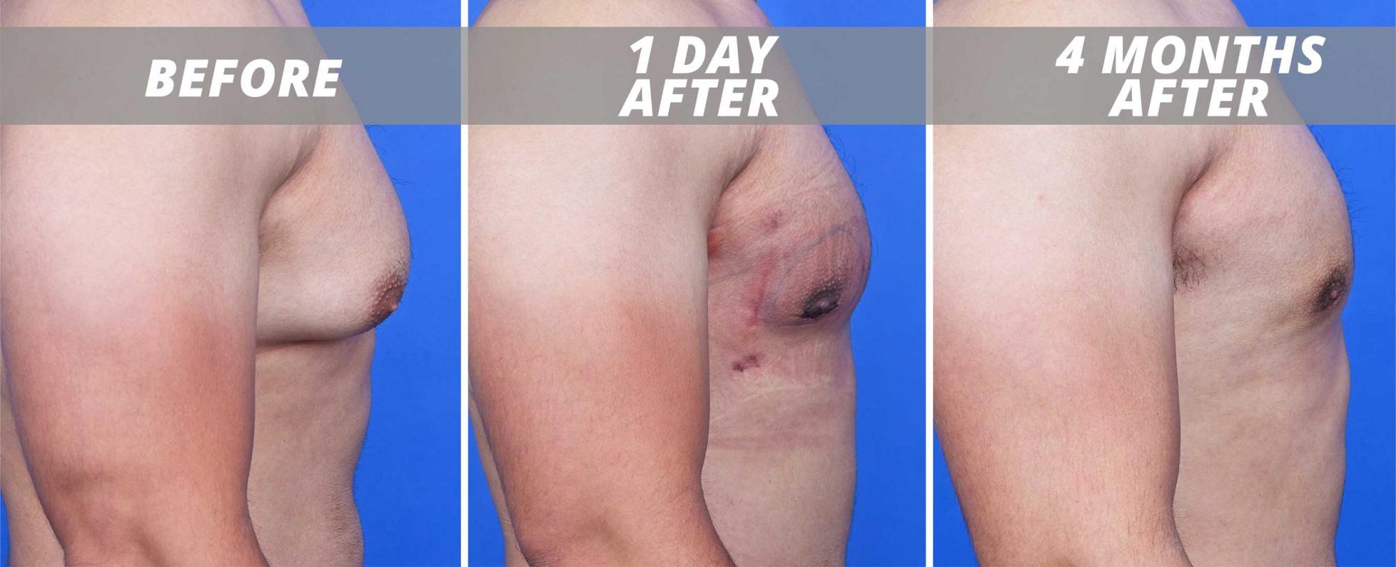 Man 4 months after gynecomastia surgery