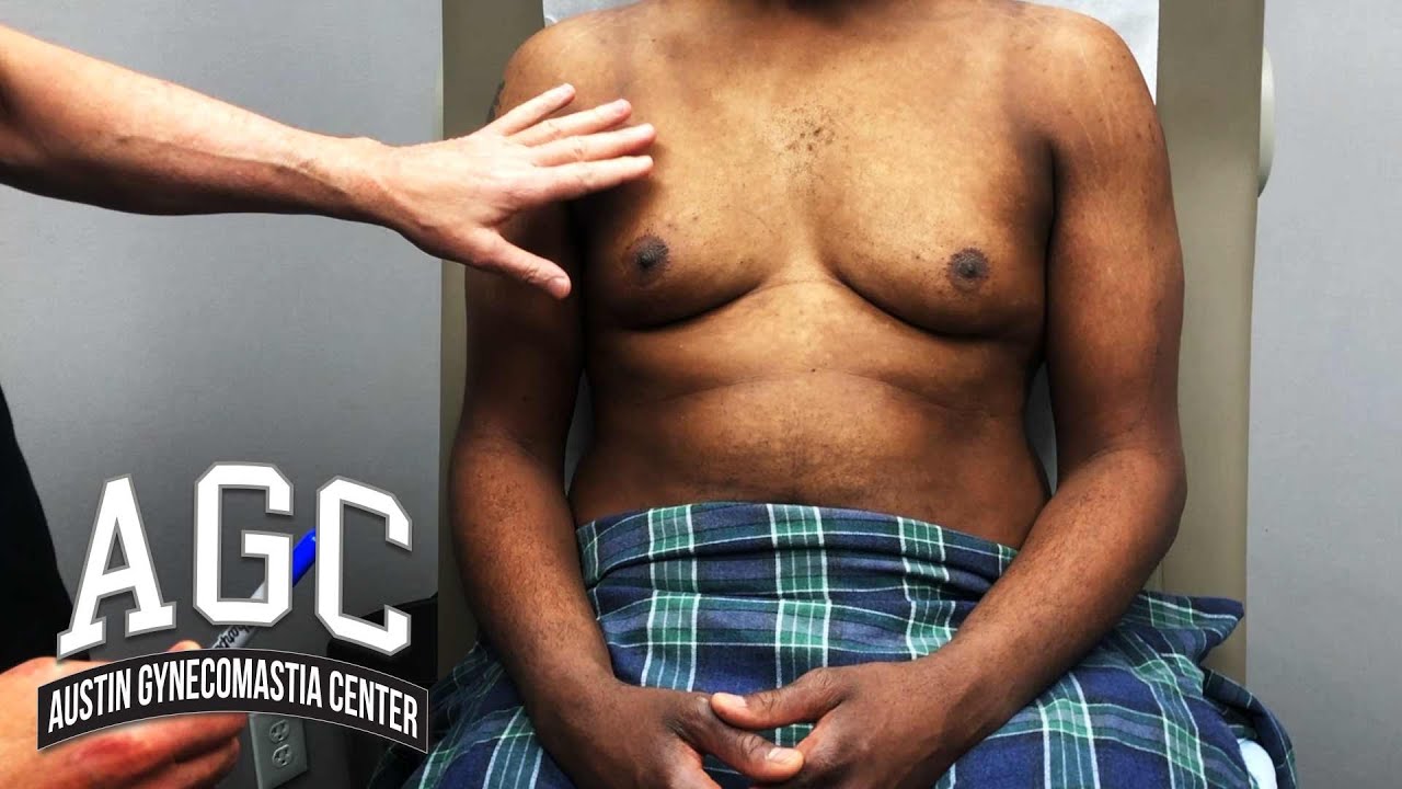 AGC Gynecomastia patient video