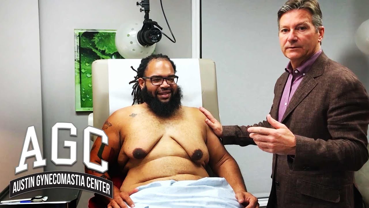 Huge Gynecomastia reduction with skin removal video