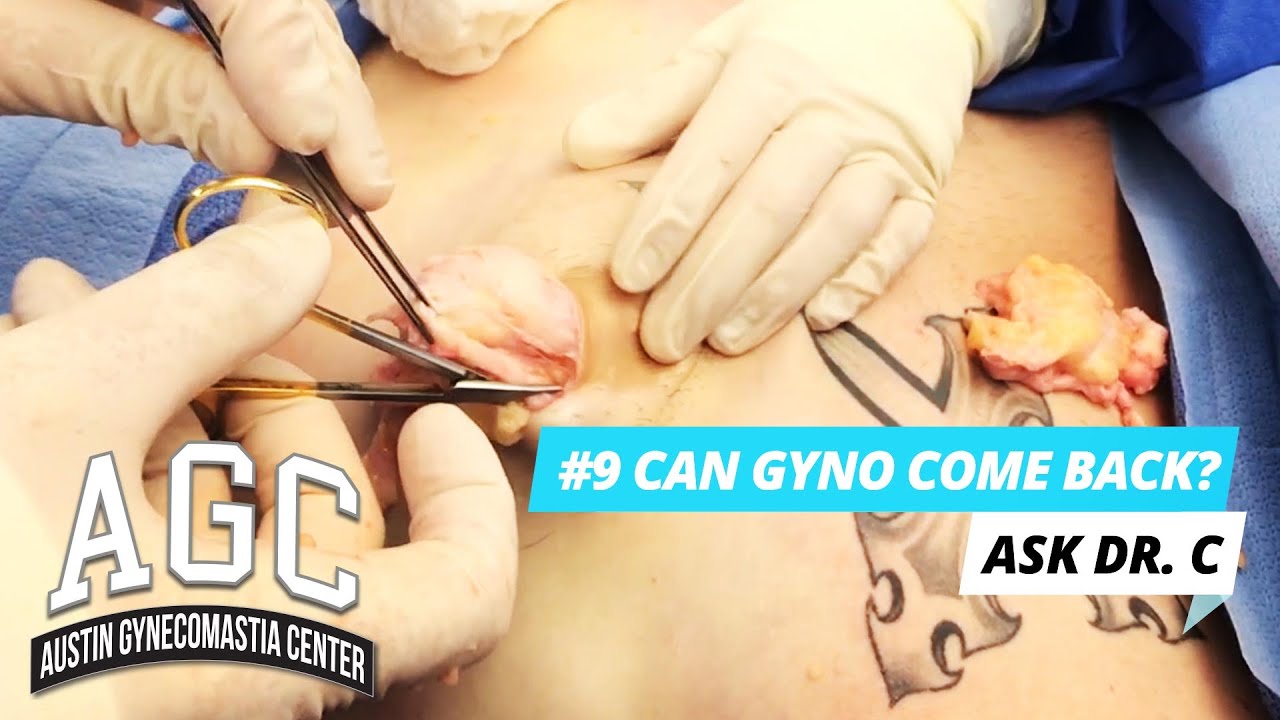 Can Gynecomastia come back? Video