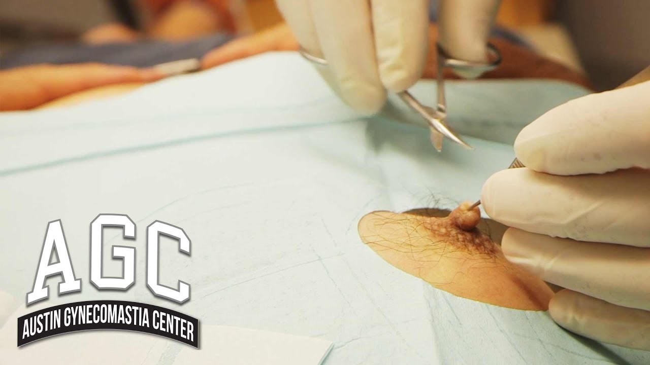 Male nipple reduction video