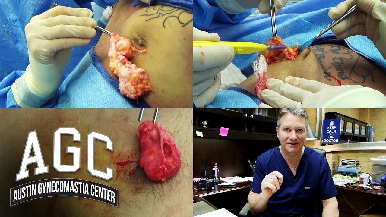 Gynecomastia gland pullout video