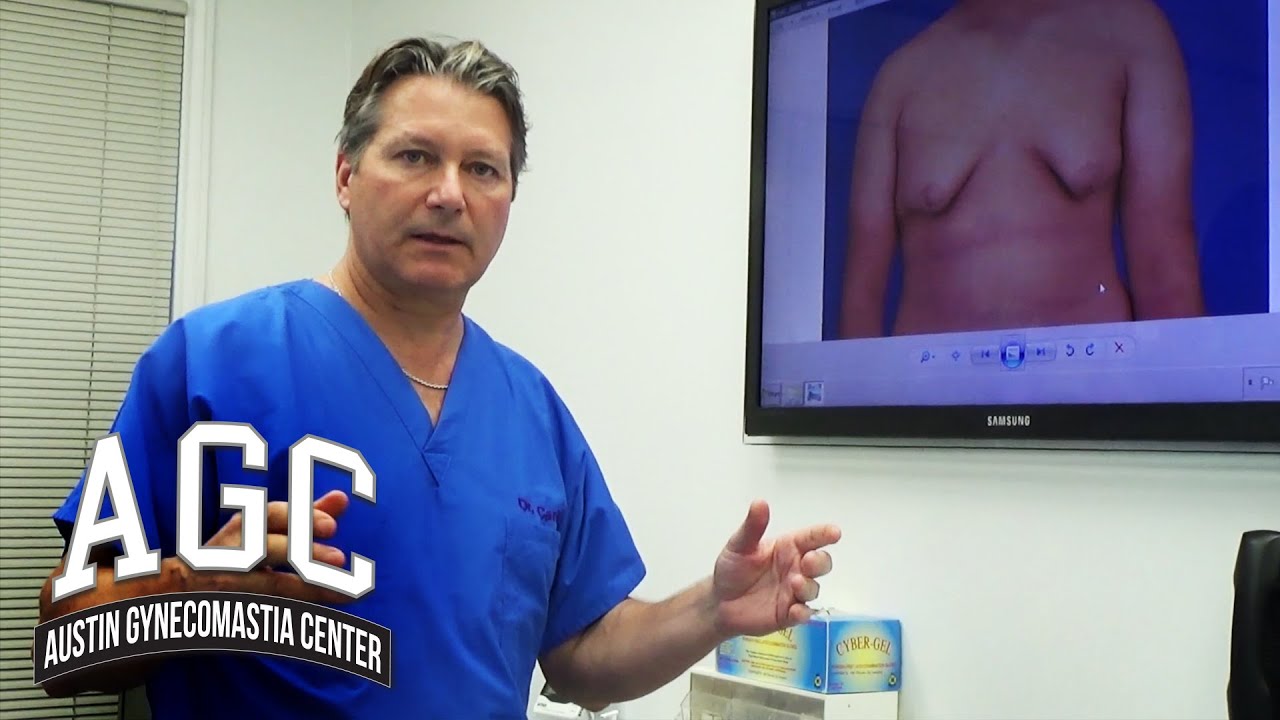 Gynecomastia and ptosis video